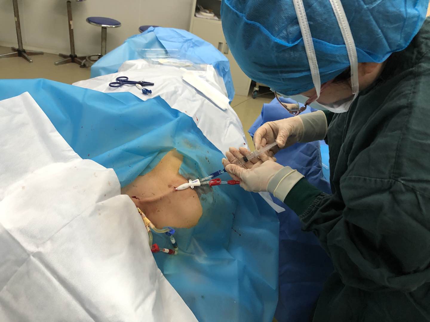 我院肾内科自主完成首例长期透析导管置入术