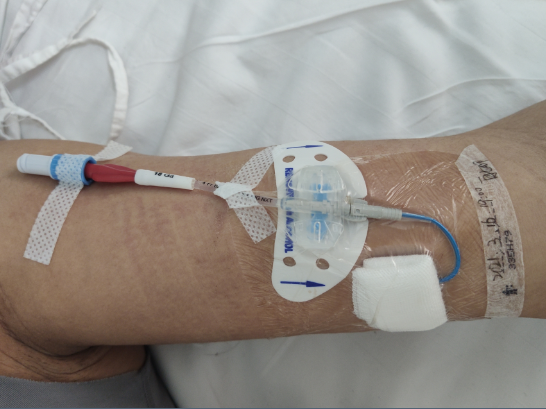 我院成功开展首例picc置管术(经外周静脉置入中心静脉导管穿刺术) 将